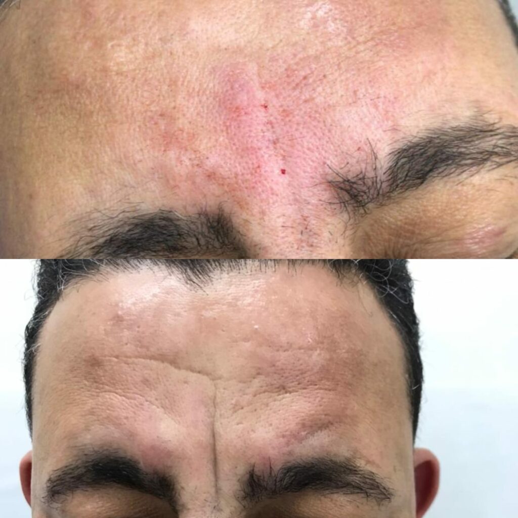 جلسات العناية بالبشرة للرجال قبل وبعد